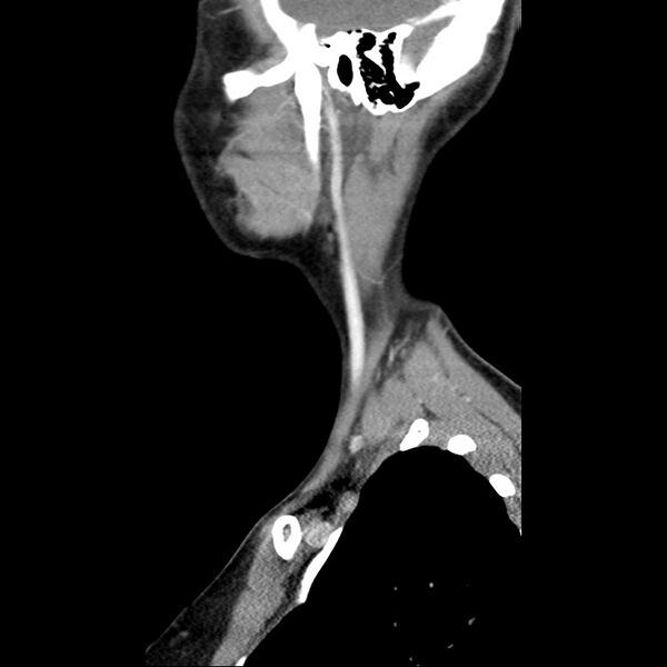 File:Normal CT of the neck (Radiopaedia 14575-14500 Sagittal C+ 10).jpg