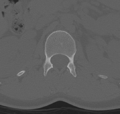 Normal lumbar spine CT (Radiopaedia 46533-50986 Axial bone window 9).png
