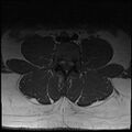 Normal lumbar spine MRI (Radiopaedia 47857-52609 Axial T1 13).jpg