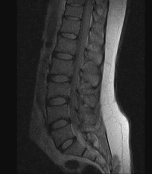 File:Normal lumbar spine MRI - low-field MRI scanner (Radiopaedia 40976-43699 Sagittal T1 7).jpg