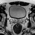 Normal prostate (MRI) (Radiopaedia 29986-30535 Axial T2 17).jpg