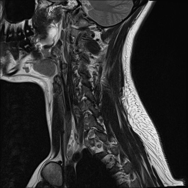 File:Normal trauma cervical spine MRI (Radiopaedia 32130-33071 Sagittal T2 15).jpg