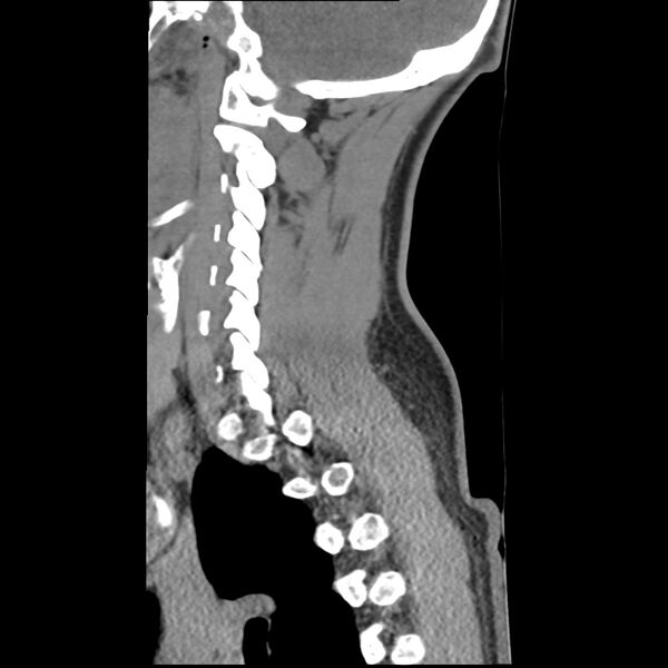 File:Normal trauma spine imaging (Radiopaedia 31753-32686 A 11).jpg