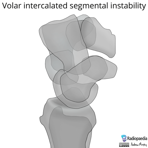 File:Normal wrist alignment, dorsal and volar intercalated segmental instability (illustration) (Radiopaedia 80949-94490 A 3).png