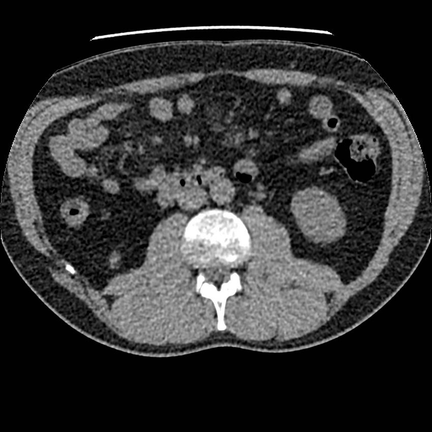 Obstructing ureteric calculus and ureteric anatomy (Radiopaedia 62730-71042 Axial non-contrast 58).jpg