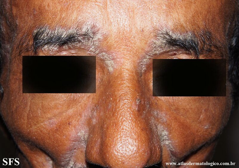 File:Psoriasis (Dermatology Atlas 133).jpg