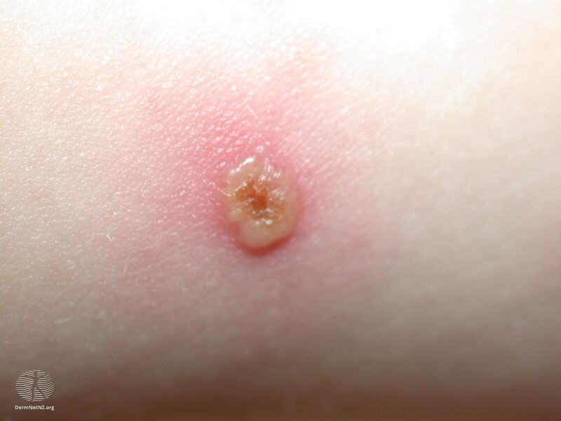 File:Varicella (DermNet NZ figure-31-fever+rash).jpg