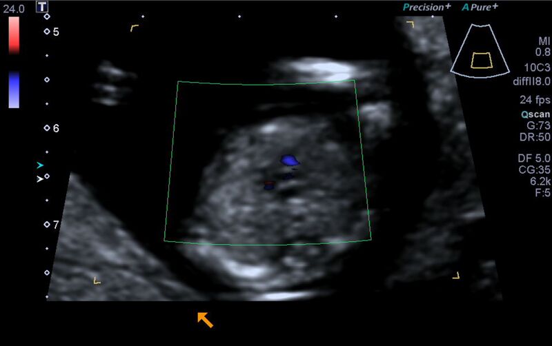 File:1st trimester nuchal-morphology ultrasound (Radiopaedia 44706-48477 Heart views cine with colour 118).jpg