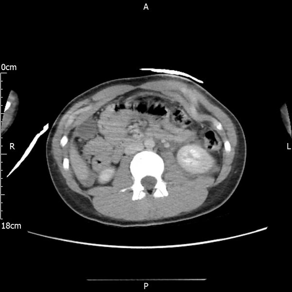 File:AAST grade IV kidney injury with CEUS follow-up (Radiopaedia 72353-82877 Axial C+ portal venous phase 32).jpg