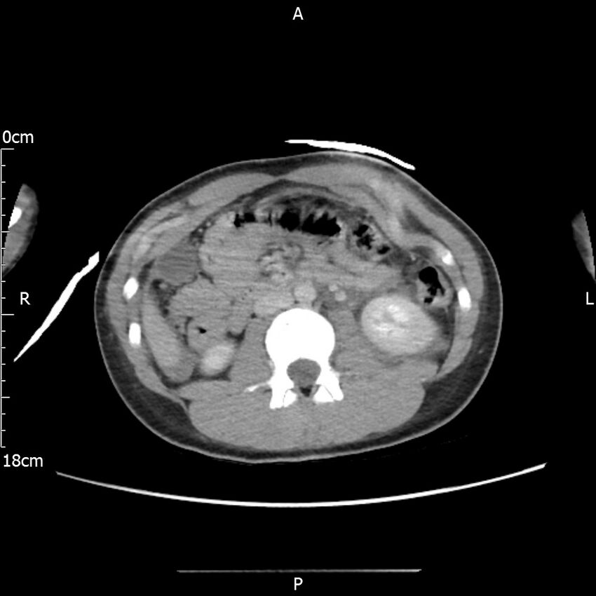 AAST grade IV kidney injury with CEUS follow-up (Radiopaedia 72353-82877 Axial C+ portal venous phase 32).jpg