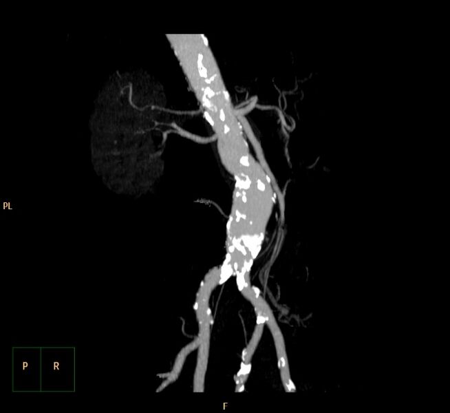 File:Abdominal aortic aneurysm (Radiopaedia 23703-23856 MIP 10).jpg