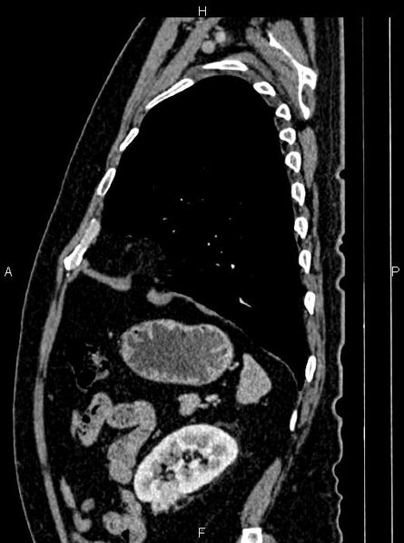 File:Abdominal aortic aneurysm (Radiopaedia 83094-97462 Sagittal renal cortical phase 96).jpg