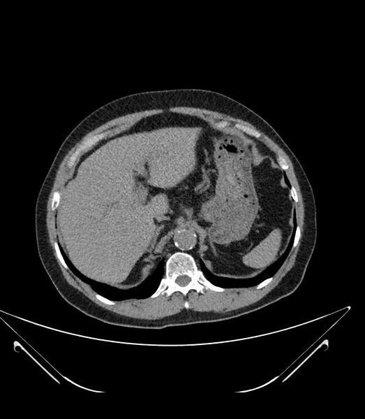 File:Abdominal aortic aneurysm with thrombus fissuration (Radiopaedia 46218-50618 Axial non-contrast 11).jpg
