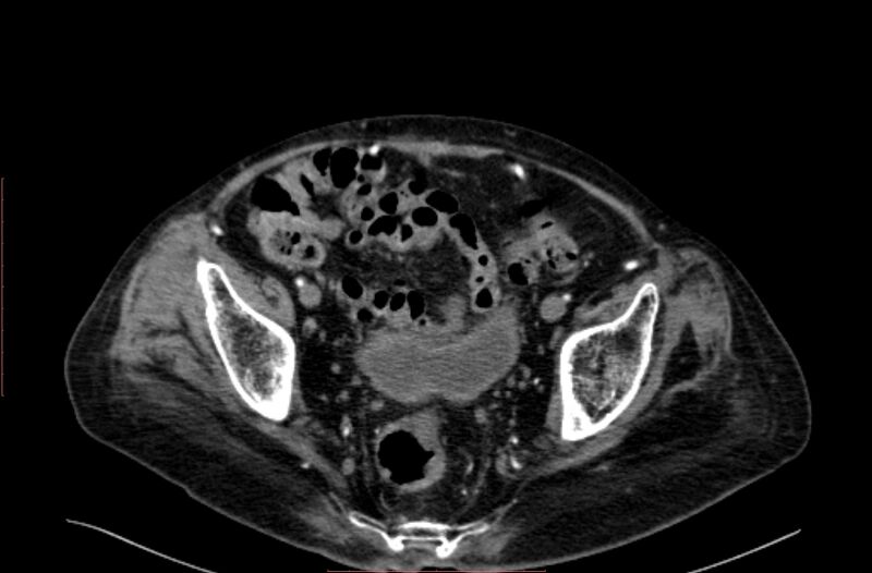 File:Abdominal aortic interposition tube graft and aneurysm thrombosis (Radiopaedia 71438-81857 Axial C+ arterial phase 202).jpg