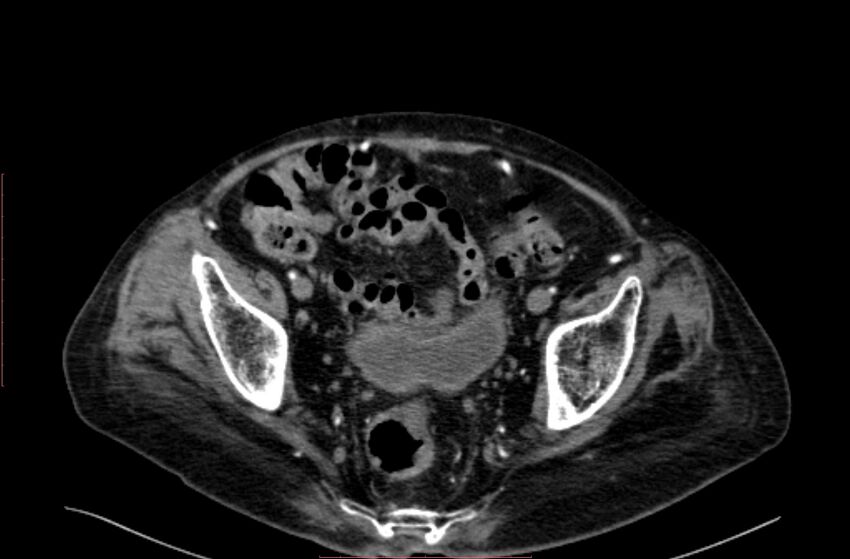 Abdominal aortic interposition tube graft and aneurysm thrombosis (Radiopaedia 71438-81857 Axial C+ arterial phase 202).jpg