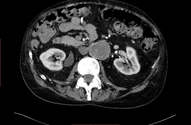 File:Abdominal aortic interposition tube graft and aneurysm thrombosis (Radiopaedia 71438-81857 Axial C+ arterial phase 60).jpg