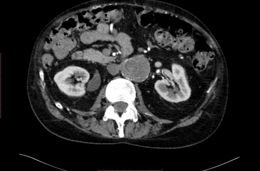 Abdominal aortic interposition tube graft and aneurysm thrombosis (Radiopaedia 71438-81857 Axial C+ arterial phase 60).jpg