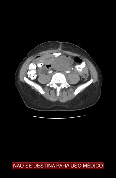 File:Abdominal desmoid tumor (Radiopaedia 44024-47540 Axial C+ arterial phase 24).jpg