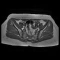 Abdominal wall endometriosis (Radiopaedia 83702-98847 Axial T1 6).jpg