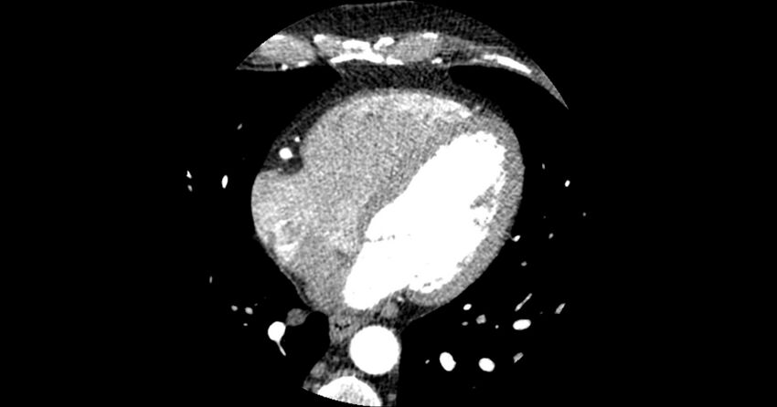 Aberrant left main coronary artery (ALMCA) arising from the right sinus with interarterial course (Radiopaedia 63251-71814 Axial C+ arterial phase 121).JPG