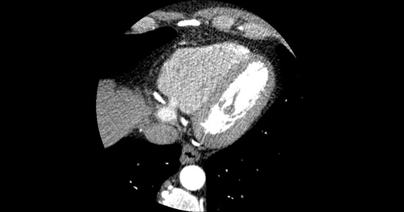 File:Aberrant left main coronary artery (ALMCA) arising from the right sinus with interarterial course (Radiopaedia 63251-71814 Axial C+ arterial phase 161).JPG