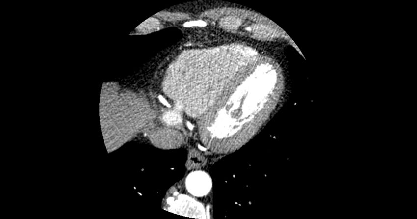 Aberrant left main coronary artery (ALMCA) arising from the right sinus with interarterial course (Radiopaedia 63251-71814 Axial C+ arterial phase 161).JPG