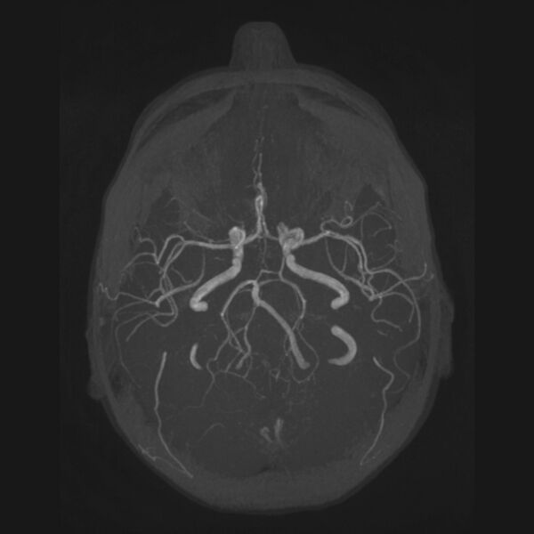 File:Accessory middle cerebral artery and ICA aneurysm (Radiopaedia 22656-22674 B 17).jpg