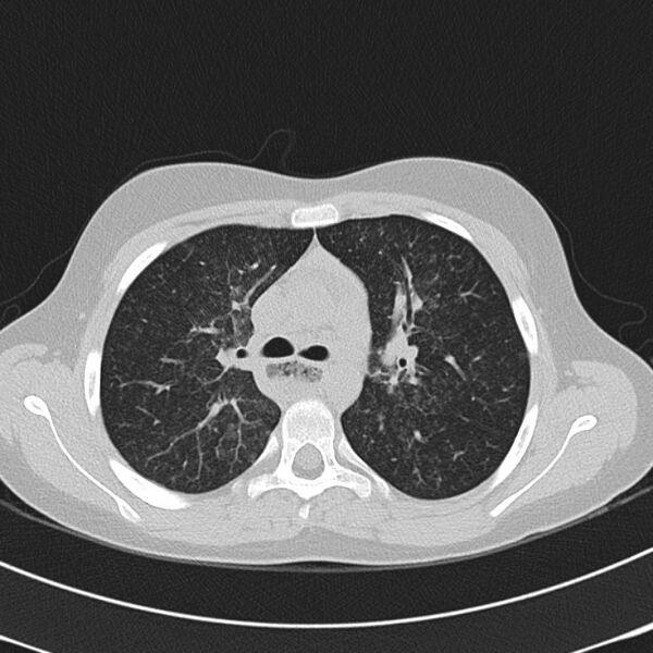 File:Achalasia (Radiopaedia 14946-14878 Axial lung window 25).jpg