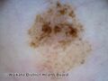 Acral lentiginous melanoma 3 dermoscopy (DermNet NZ alm-3-dermoscopy).jpg