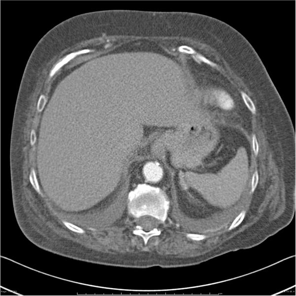 File:Acute-on-chronic pulmonary emboli (Radiopaedia 27925-28169 C+ CTPA 75).jpg