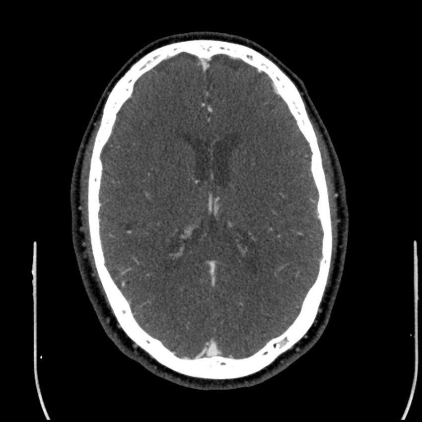 Acute A3 occlusion with ACA ischemic penumbra (CT perfusion) (Radiopaedia 72036-82527 Axial C+ arterial phase thins 50).jpg