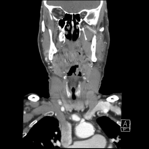 File:Acute ICA ischemic penumbra due to high-grade CCA stenosis (CT perfusion) (Radiopaedia 72038-82530 Coronal C+ arterial phase 11).jpg