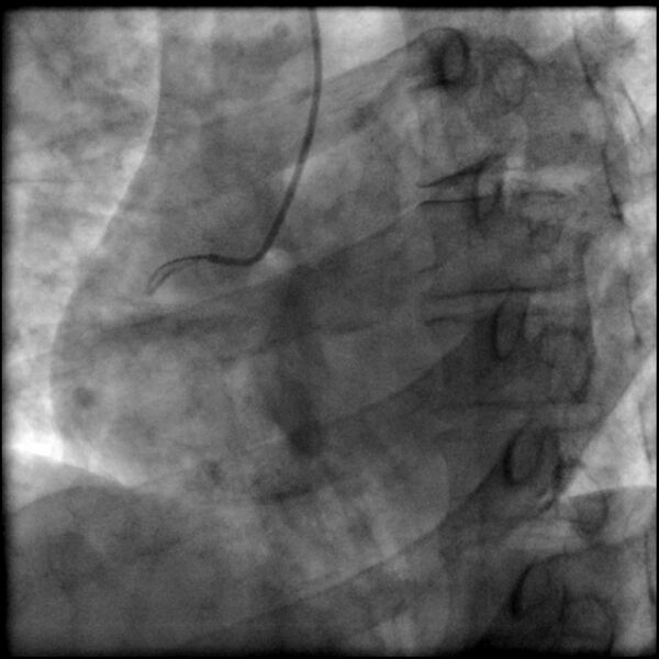 File:Acute anteroseptal myocardial infarction (Radiopaedia 68409-77946 RAO straight RCA 7).jpg