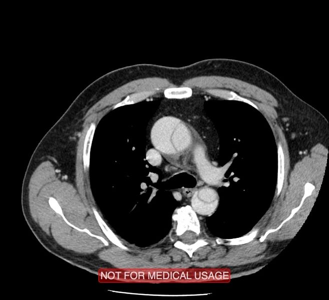 File:Acute aortic dissection - Stanford type A (Radiopaedia 40661-43285 Axial C+ portal venous phase 13).jpg