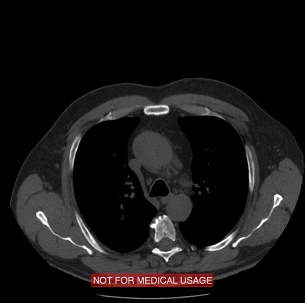 File:Acute aortic dissection - Stanford type A (Radiopaedia 40661-43285 Axial non-contrast 12).jpg
