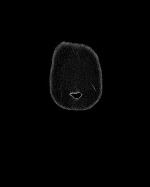 File:Acute appendicitis - large appendicoliths (Radiopaedia 61805-69820 Coronal C+ portal venous phase 3).jpg