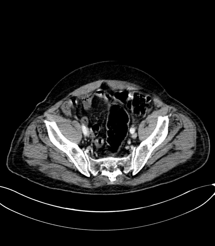 Acute arterial mesenteric ischemia (Radiopaedia 78238-90828 Axial C+ portal venous phase 117).jpg