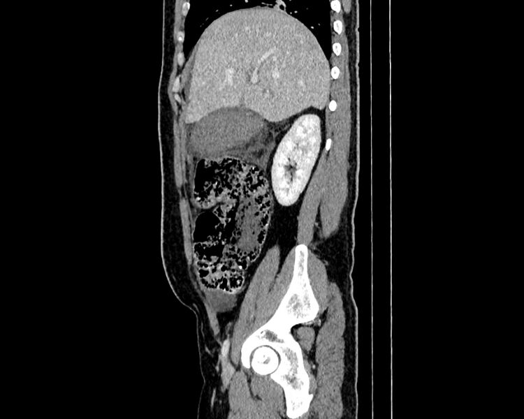 File:Acute cholecystitis (Radiopaedia 53216-59182 Sagittal C+ portal venous phase 6).jpg