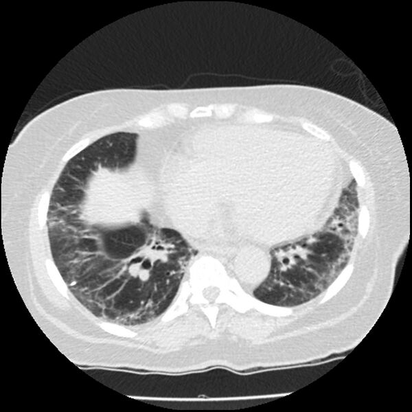 File:Acute interstitial pneumonitis (Radiopaedia 45404-49444 Axial lung window 71).jpg