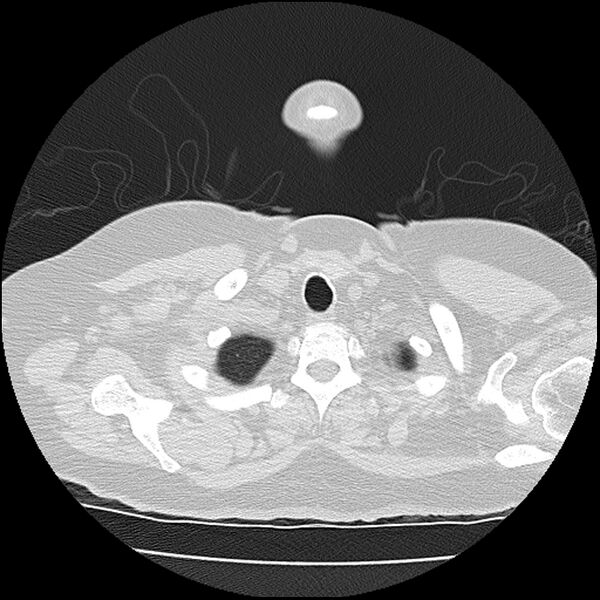 File:Acute interstitial pneumonitis (Radiopaedia 45404-49452 Axial lung window 4).jpg