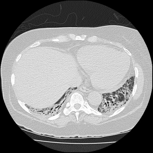 File:Acute interstitial pneumonitis (Radiopaedia 45404-49452 Axial lung window 70).jpg