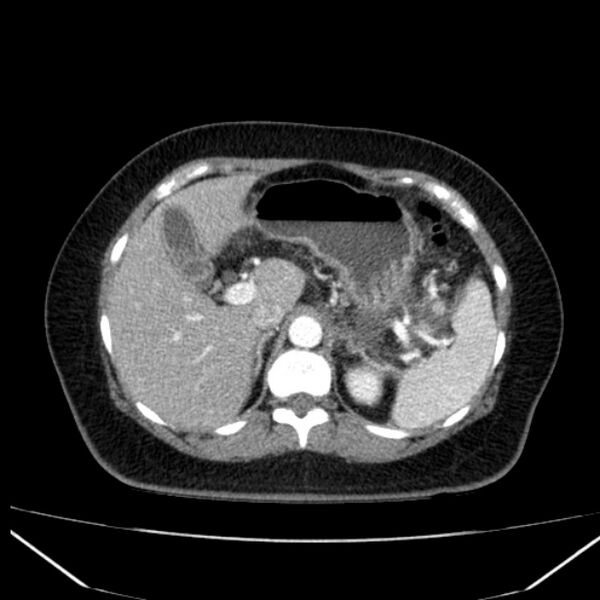 File:Acute pancreatitis - Balthazar C (Radiopaedia 26569-26714 Axial C+ arterial phase 24).jpg