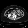 Acute pancreatitis - Balthazar C (Radiopaedia 26569-26714 Axial C+ portal venous phase 52).jpg