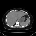 Acute pancreatitis - Balthazar C (Radiopaedia 26569-26714 Axial non-contrast 22).jpg
