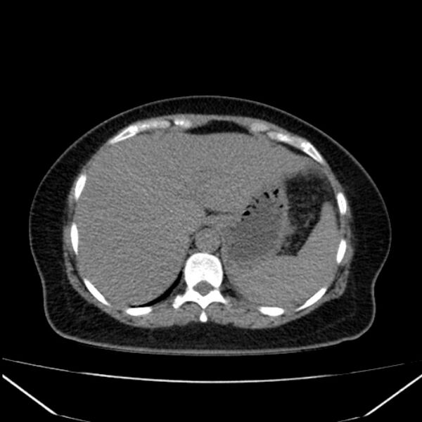 File:Acute pancreatitis - Balthazar C (Radiopaedia 26569-26714 Axial non-contrast 22).jpg