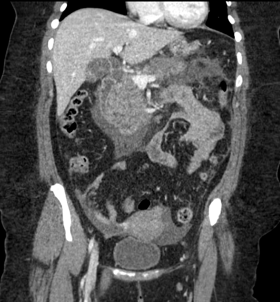File:Acute pancreatitis - Balthazar E (Radiopaedia 29016-29377 Coronal C+ portal venous phase 43).png