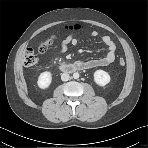 File:Acute pancreatitis - mild (Radiopaedia 27796-28033 C+ portal venous phase 27).jpg