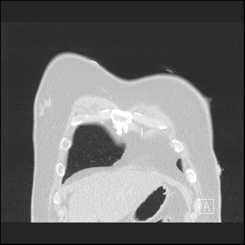 Acute pulmonary embolism with pulmonary infarct (Radiopaedia 73062-83768 Coronal lung window 5).jpg