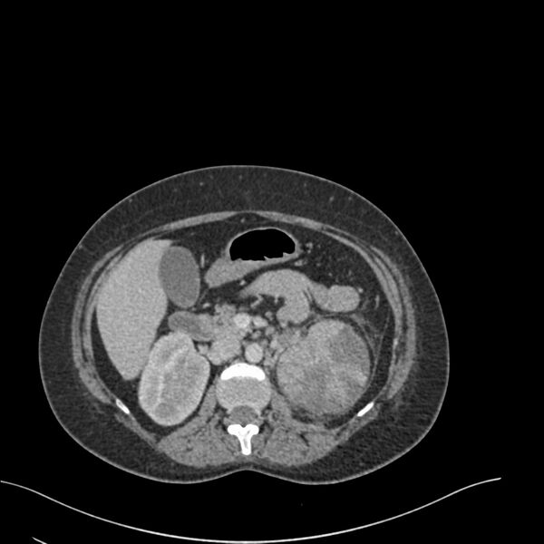 File:Acute pyelonephritis with renal vein thrombosis (Radiopaedia 58020-65053 Axial renal parenchymal phase 50).jpg