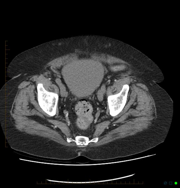 File:Acute renal failure post IV contrast injection- CT findings (Radiopaedia 47815-52557 Axial non-contrast 70).jpg